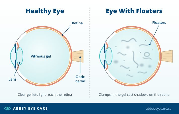 Diagram comparing a healthy eye with clear vitreous gel to an eye with floaters, where clumps in the gel cast shadows on the retina.