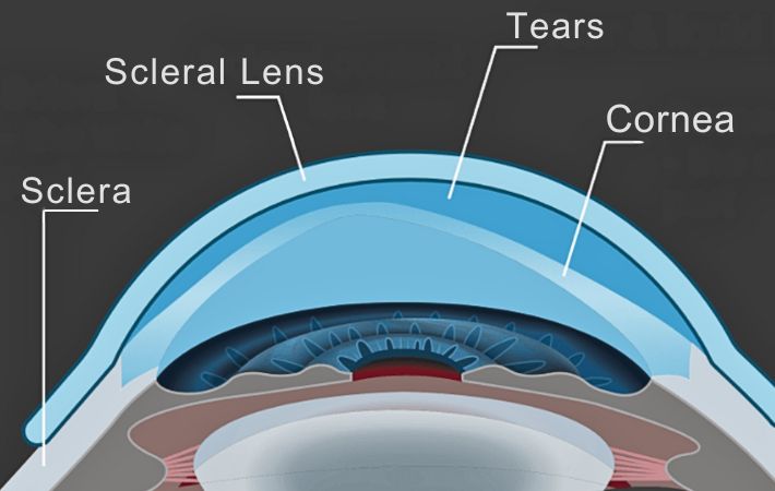 Advantages Of Scleral Lenses: A Complete Guide | Abbey Eye Care