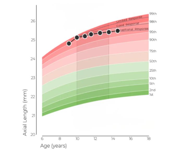 measuring axial length myopia management