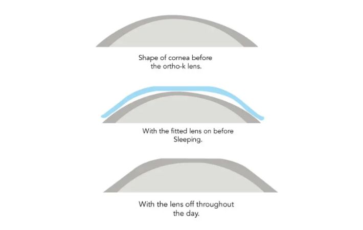 Diagram showing three stages: the natural shape of the cornea, cornea with an ortho-k lens fitted before sleep, and the reshaped cornea after removing the lens during the day.